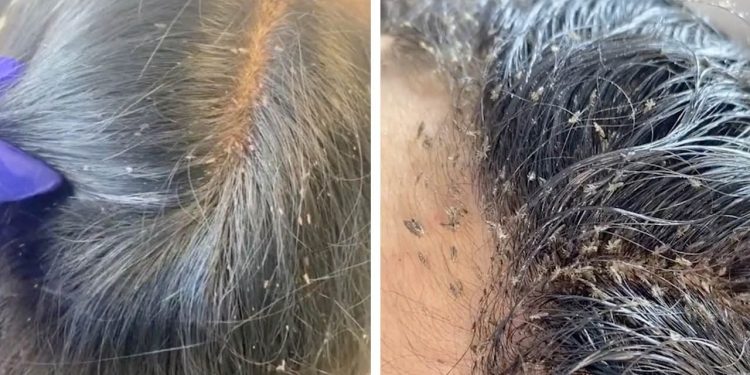 இலங்கையில் அதிகரித்துள்ள பேன் தொல்லை