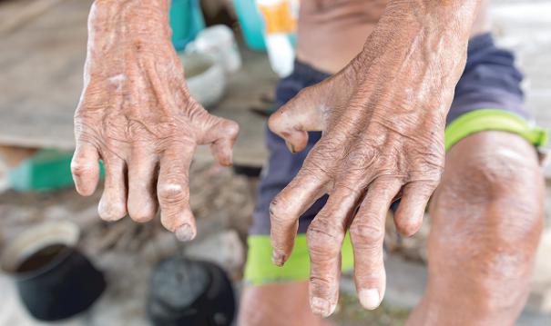 நாட்டில் தொழுநோயாளர்களின் எண்ணிக்கை அதிகரிப்பு!