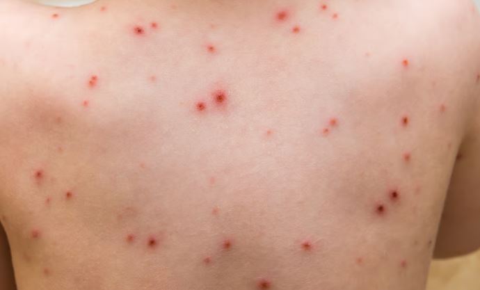 கேரளாவில் தீவிரமடைந்து வரும் அம்மை நோய்! 9 பேர் உயிரிழப்பு