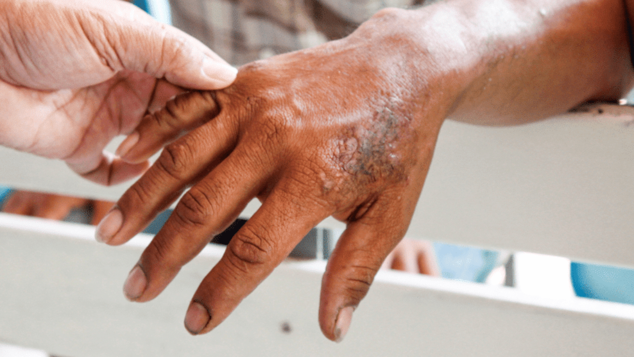 இலங்கையில் மீண்டும் தலைதூக்கும் தொழுநோய்!